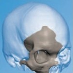 3D-печатный имплант черепа