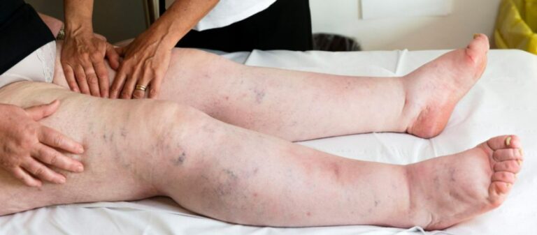 Sensación de piernas hinchadas y pesadas: cómo ayuda el drenaje linfático a mejorar el bienestar