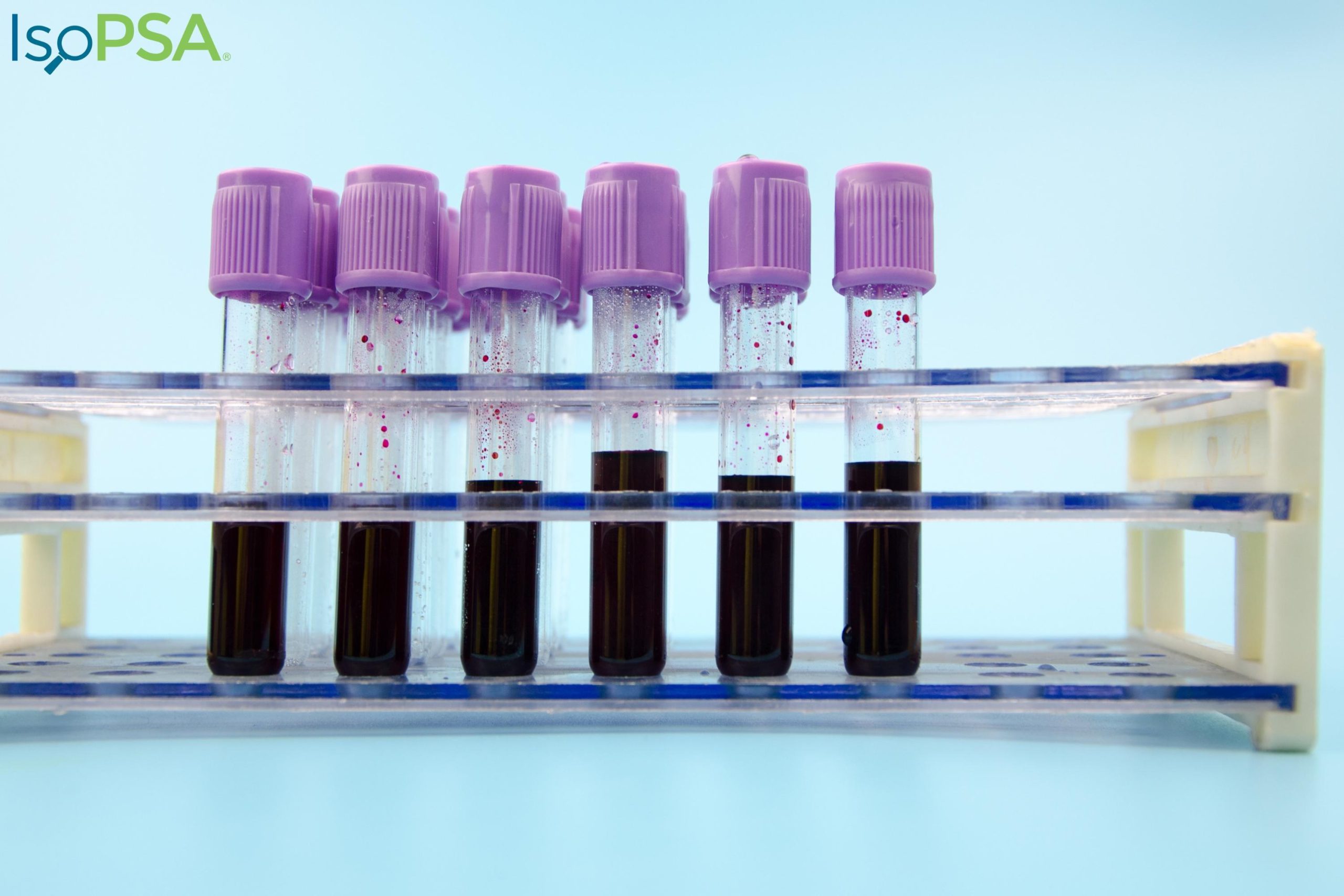 משרד הבריאות אישר בדיקת דם חדשה לאבחון סרטן הערמונית