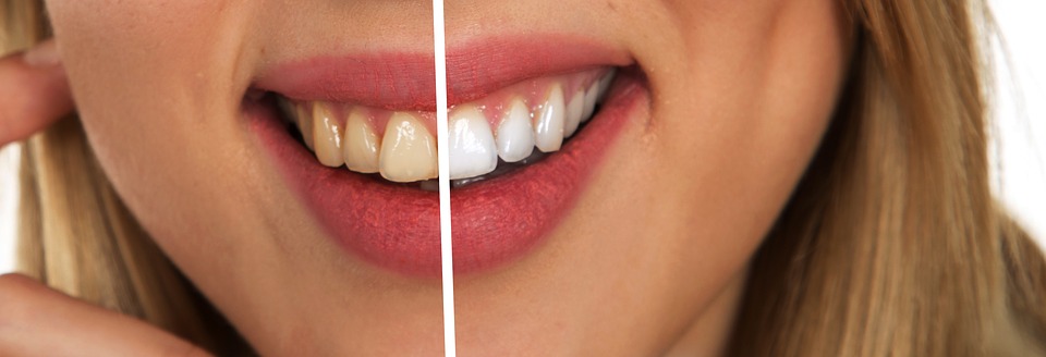 ציפוי שיניים – מה זה ולמי זה מתאים?