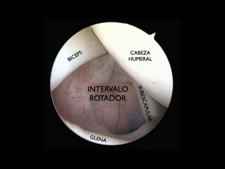 Abordaje Intervencionista en la Patología del Intervalo Rotador del Hombro – Cofim 2019