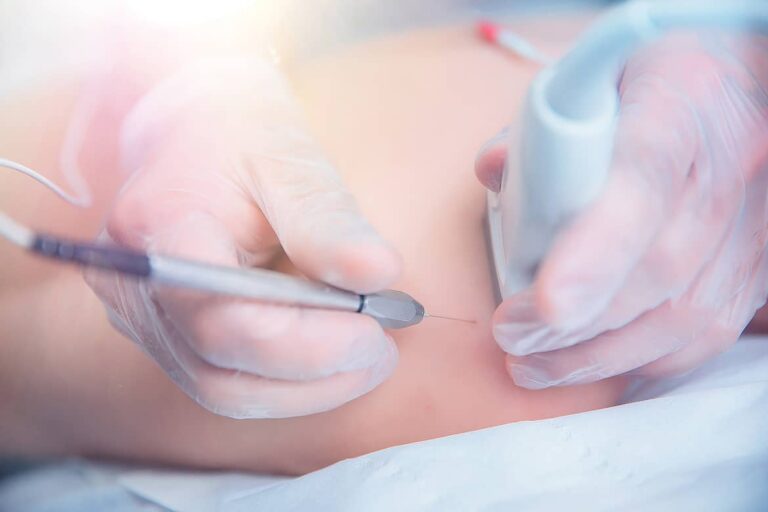 Punción Seca de Puntos Gatillo Miofasciales con Guía Electromiografía – Cofim 2019