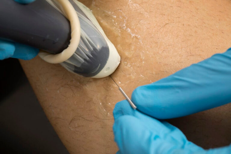 Innovación en punción seca guiada por ecografía para el manejo del dolor miofascial