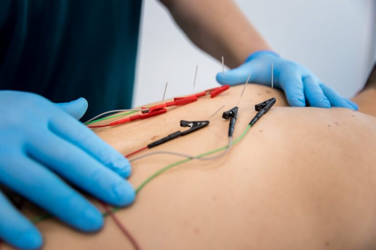 Actualización científica en neuromodulación percutánea y su aplicación clínica en fisioterapia