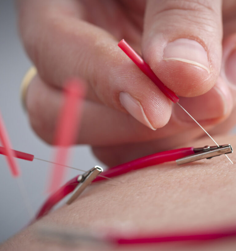 EPI® y punción seca combinadas: sinergias terapéuticas en fisioterapia musculoesquelética