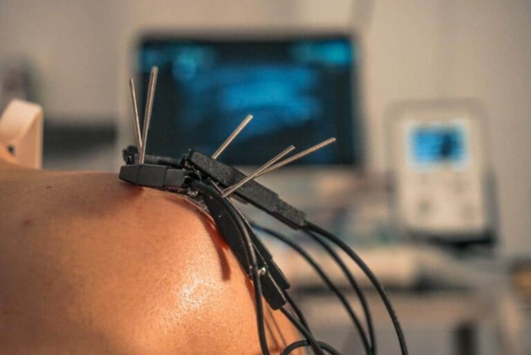 Terapias invasivas en la tendinopatía del manguito rotador: comparación entre EPI®, neuromodulación y abordaje combinado