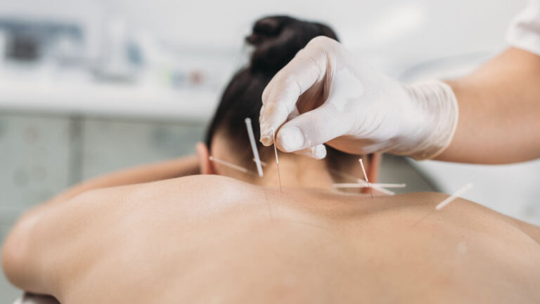 Errores frecuentes en la aplicación de punción seca en síndrome miofascial