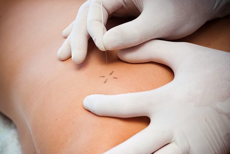 ¿Cuándo está realmente indicada la punción seca en el síndrome de dolor miofascial según la evidencia científica actual?