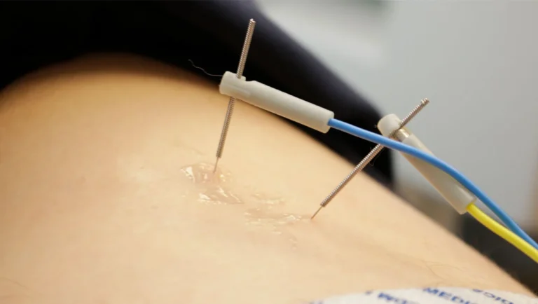 Fisioterapia invasiva en el deportista de élite: criterios de indicación y control de riesgos