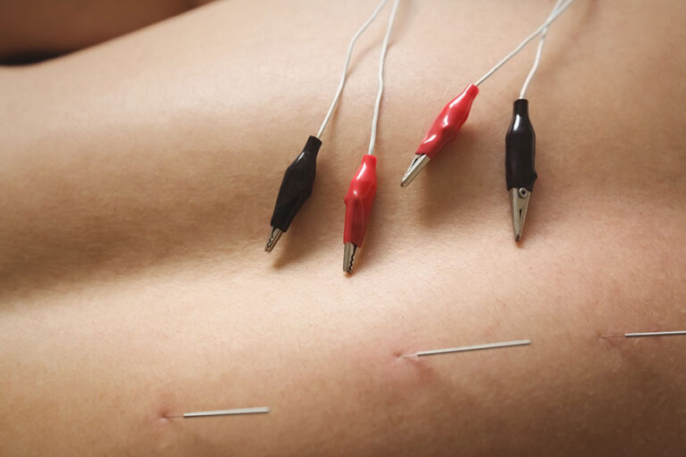 Neuromodulación percutánea en neuropatías periféricas: criterios clínicos y evidencia en fisioterapia invasiva