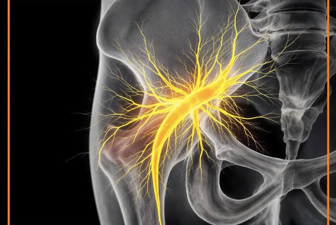 Neuromodulación ecoguiada del nervio ciático: ¿puede modificar el dolor y el equilibrio en la lumbalgia crónica?