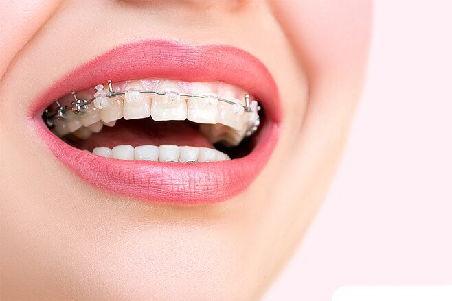 Весенние скидки на установку брекетов предлагает стоматологический центр «Зууб»