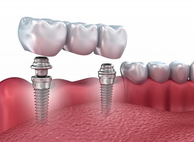 Сеть клиник «Зууб.рф» приглашает установить зубные импланты по акции