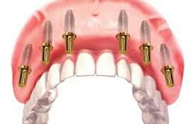 Стоматология «Зууб» запустила услугу восстановления зубов по протоколу «All-on-6»