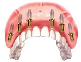 Стоматология «Зууб» запустила услугу восстановления зубов по протоколу «All-on-6»