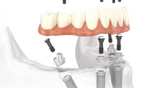 Клиника «Зууб» применяет технологию «All-on-4» для восстановления зубного ряда