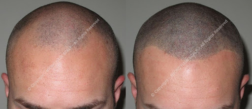 Micro Hair Scalp Tricopigmentazione Permanente