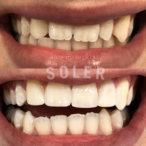 Dental Soler | Ortodoncia Invisible | Clínica Dental Valencia