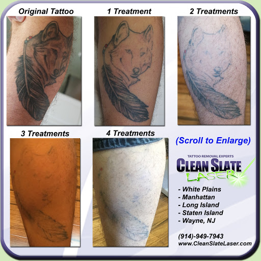 Clean Slate Laser Tattoo Removal