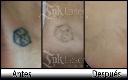 Ink Laser "Eliminar tatuajes Valencia"