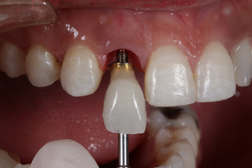 Dobleese Clínica Dental en Triana | Implantes Dentales, Carillas Dentales, Periodoncia y Dentista en Sevilla