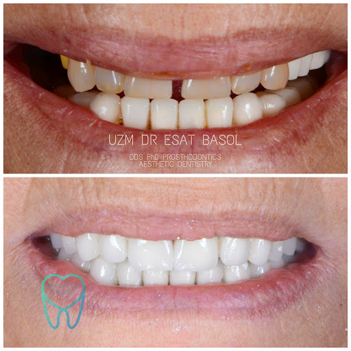 Diş Hekimi Uzm. Dr. Dt. Esat Başol, Gülüş Tasarımı ve İmplant Klinikleri. İmplant Tedavisi/ Zirkonyum/ Estetik Diş Hekimliği