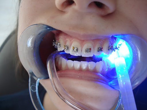 Dr.Akın Ortodonti&Diş Dr.Dt.Enver Akın Özkan Ankara Ortodonti, Estetik Diş Hekimliği, Gülüş Tasarımı
