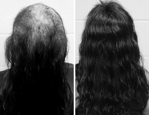 Mane Solutions - Non-Surgical Hair Replacement