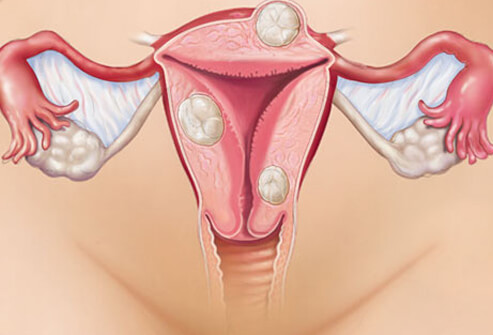 La Endometriosis