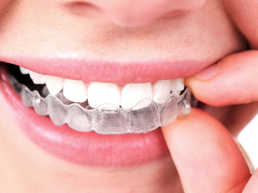Smiile Dental Center - Orthodontics - Invisalign