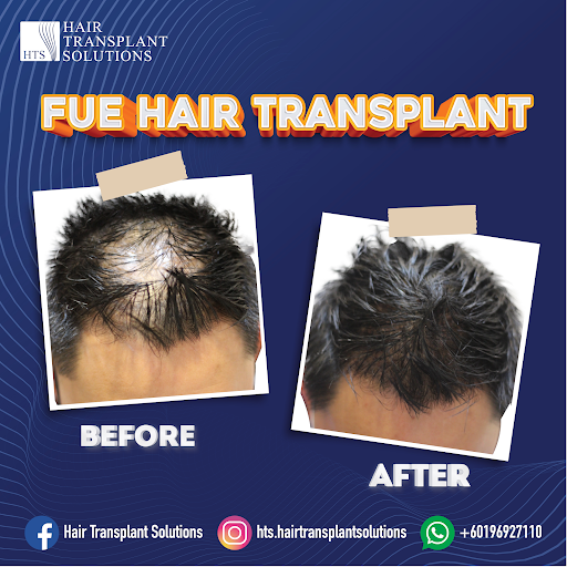 Hair Transplant Solutions @ The KL Sky Clinic