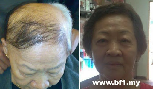 BF1 Malaysia - Control Hair Loss and Promoting Hair Growth