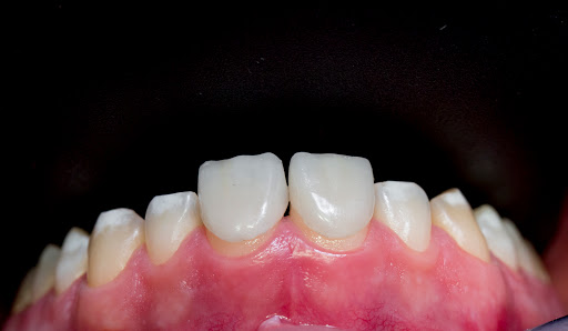 Laboratorio Protésico Dental NEWDENT - Carillas/Coronas, Prótesis sobre implantes, Cad-Cam