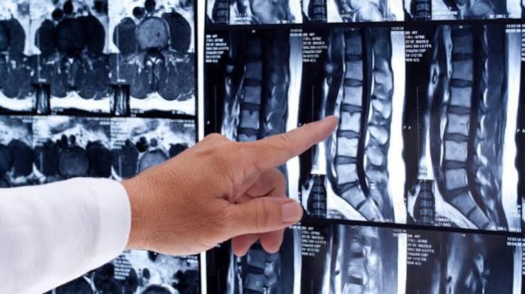 ¿Por qué me duele si la resonancia salió normal? Cómo explicar la alarma del cerebro