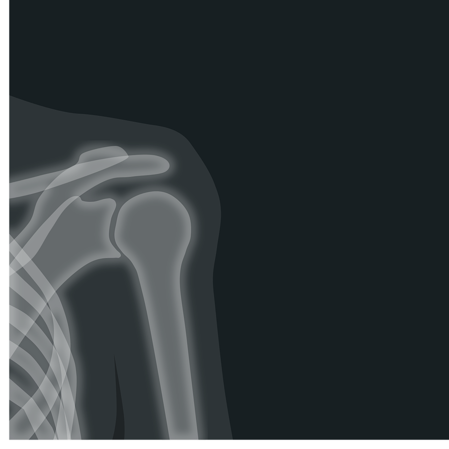 שברים בכתף – האם קיים טיפול לכל סוגי השברים?