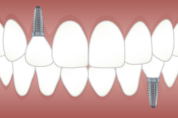 טיפולי שיניים אסתטיים ושיקומיים נפוצים
