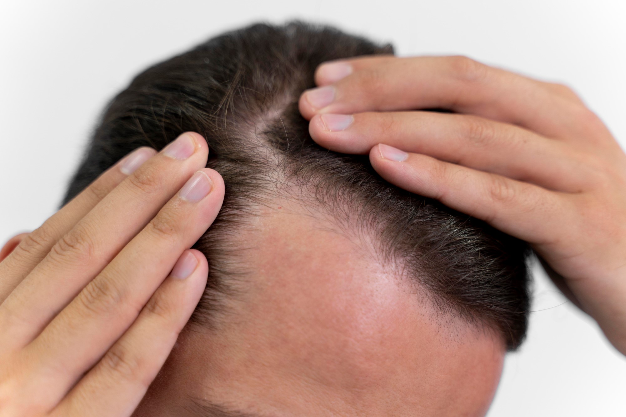 אילו פתרונות יש לדלילות שיער בקרב גברים?