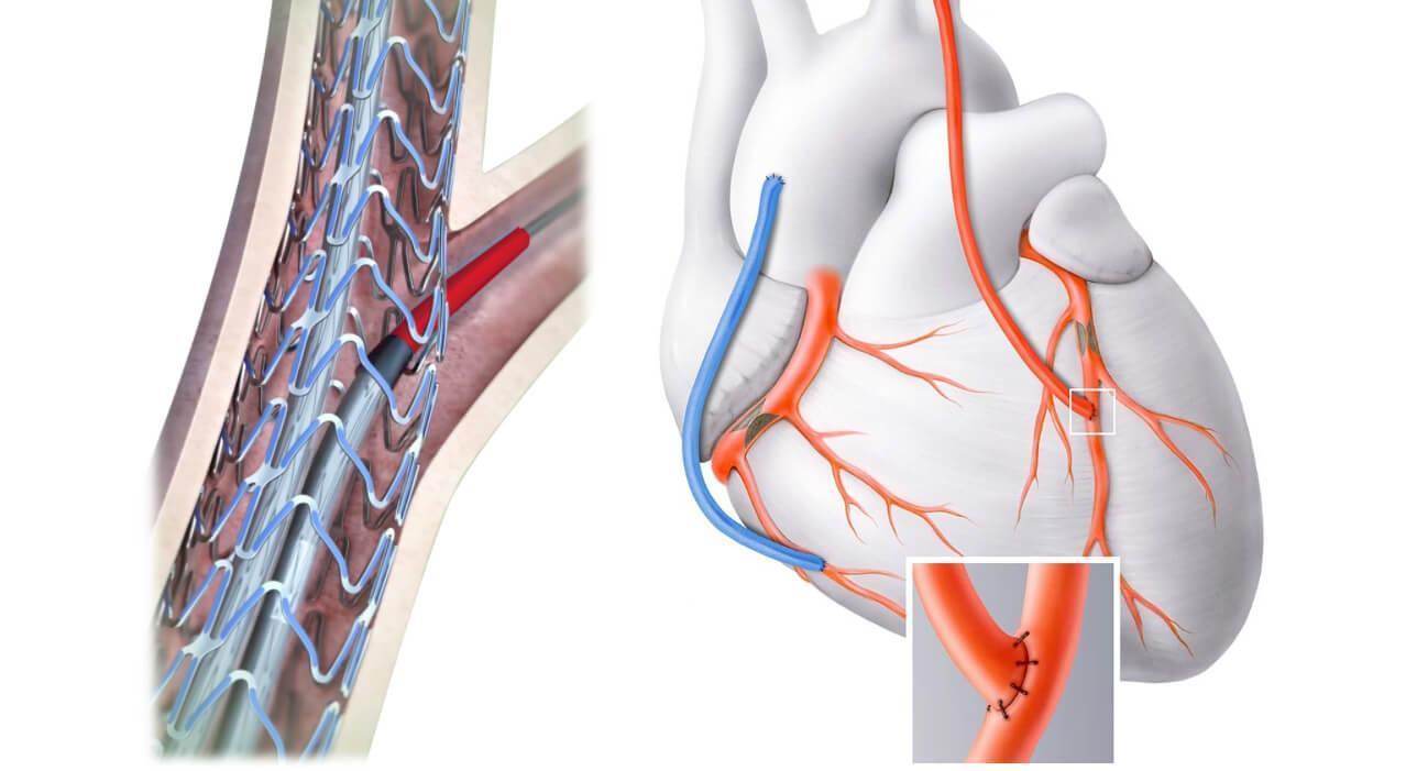 Stent mi, Bypass mı?