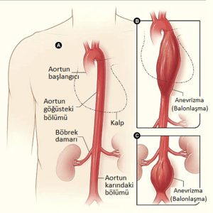 Aortic aneurysm ballooning