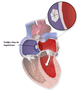 ASd'nin ameliyatsız kapatılması