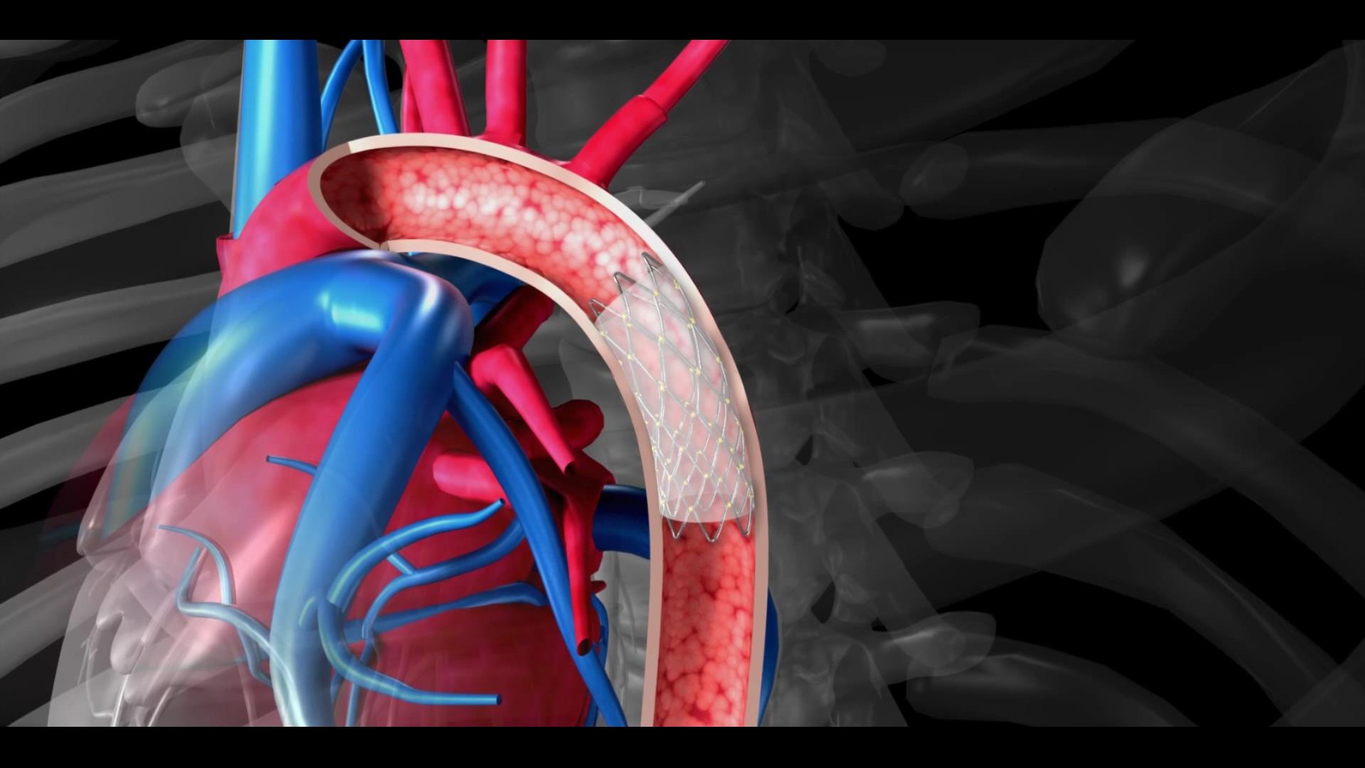 Aort koarktasyonunun stent ile ameliyatsız tedavisi