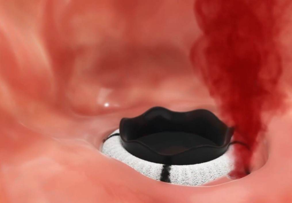 Paravalvüler kaçak nedir?