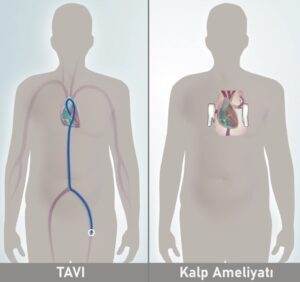 TAVR vs SAVR