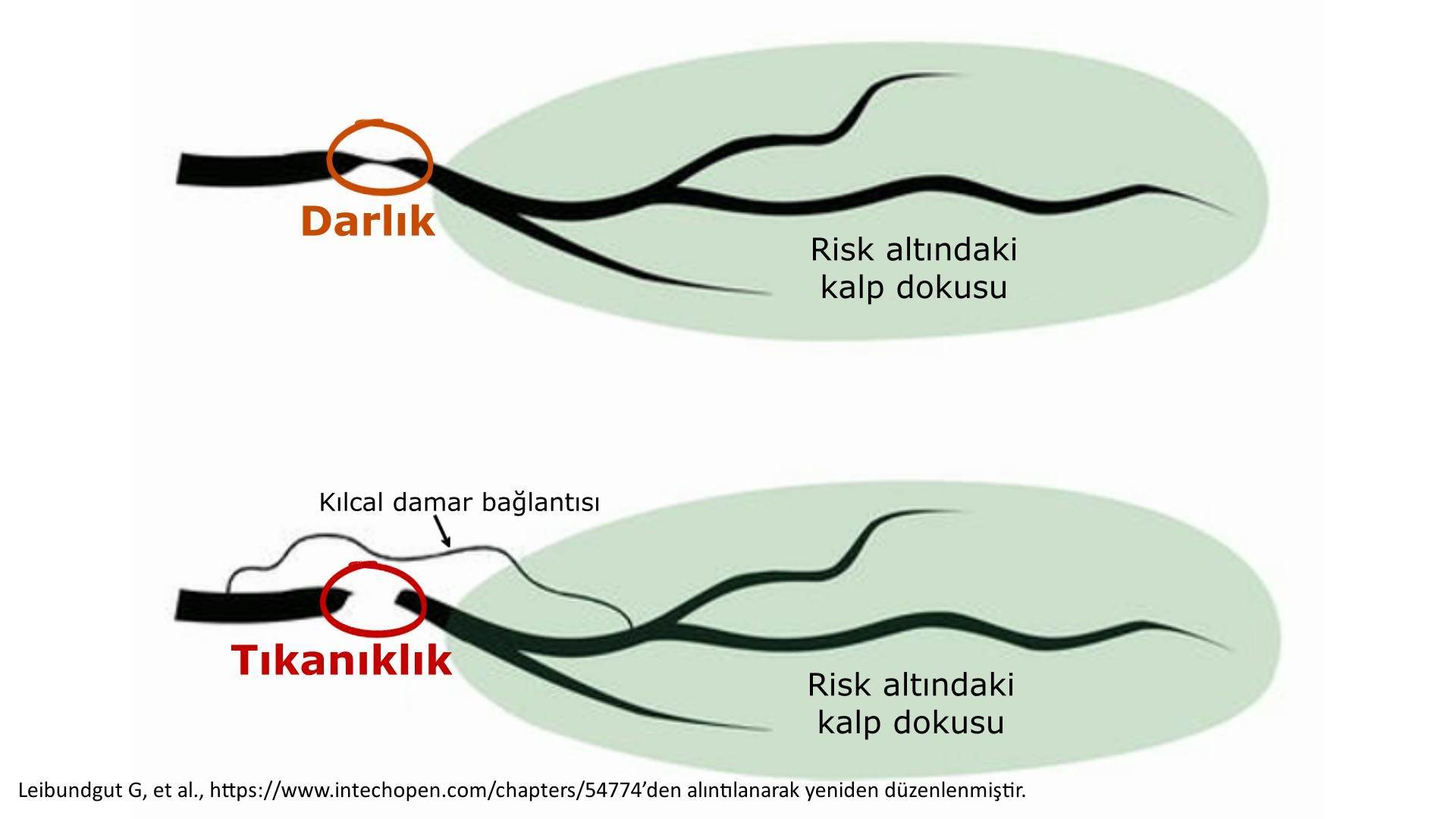 Kalp damarında darlık ve tıkanıklık arasındaki fark