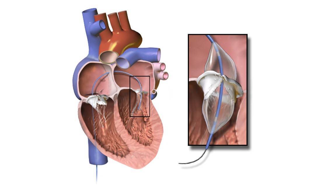 Perkütan balon mitral valvuloplasti