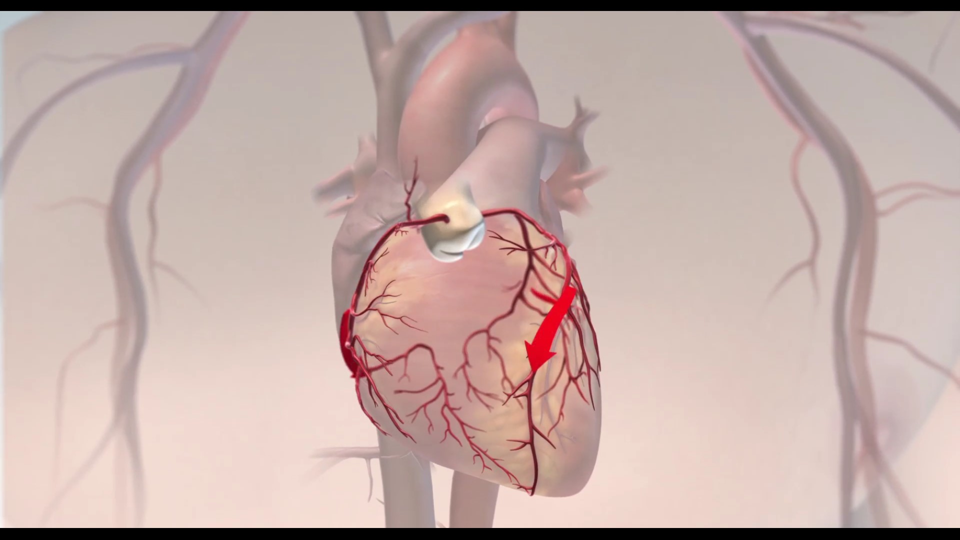 Koroner arter hastalığı