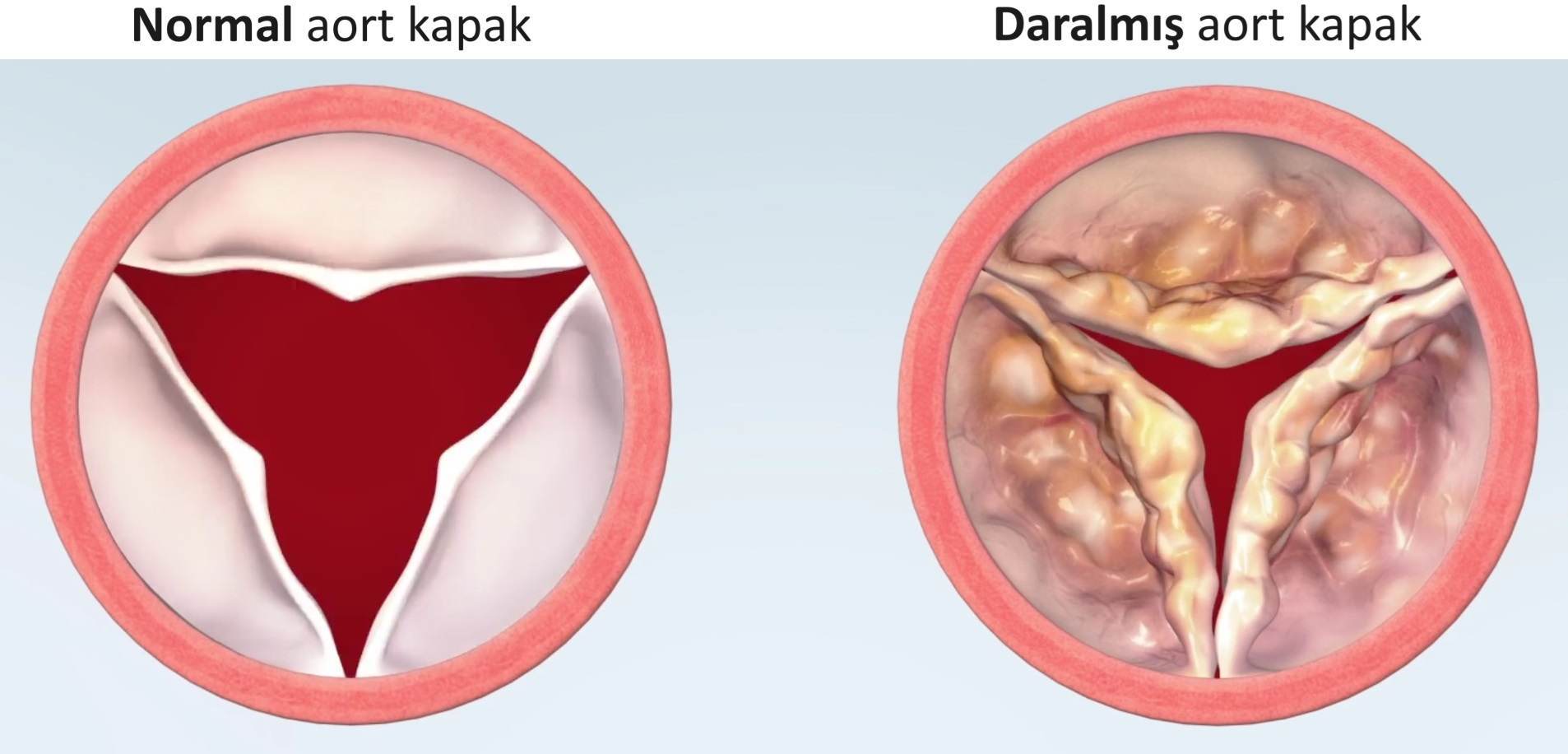 Aort kapak darlığı