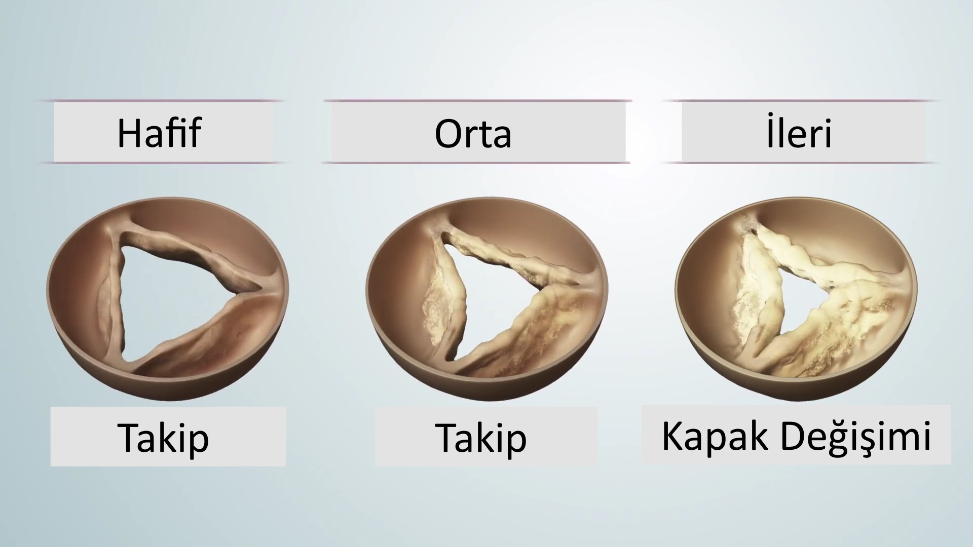 Aort darlığı evreleri