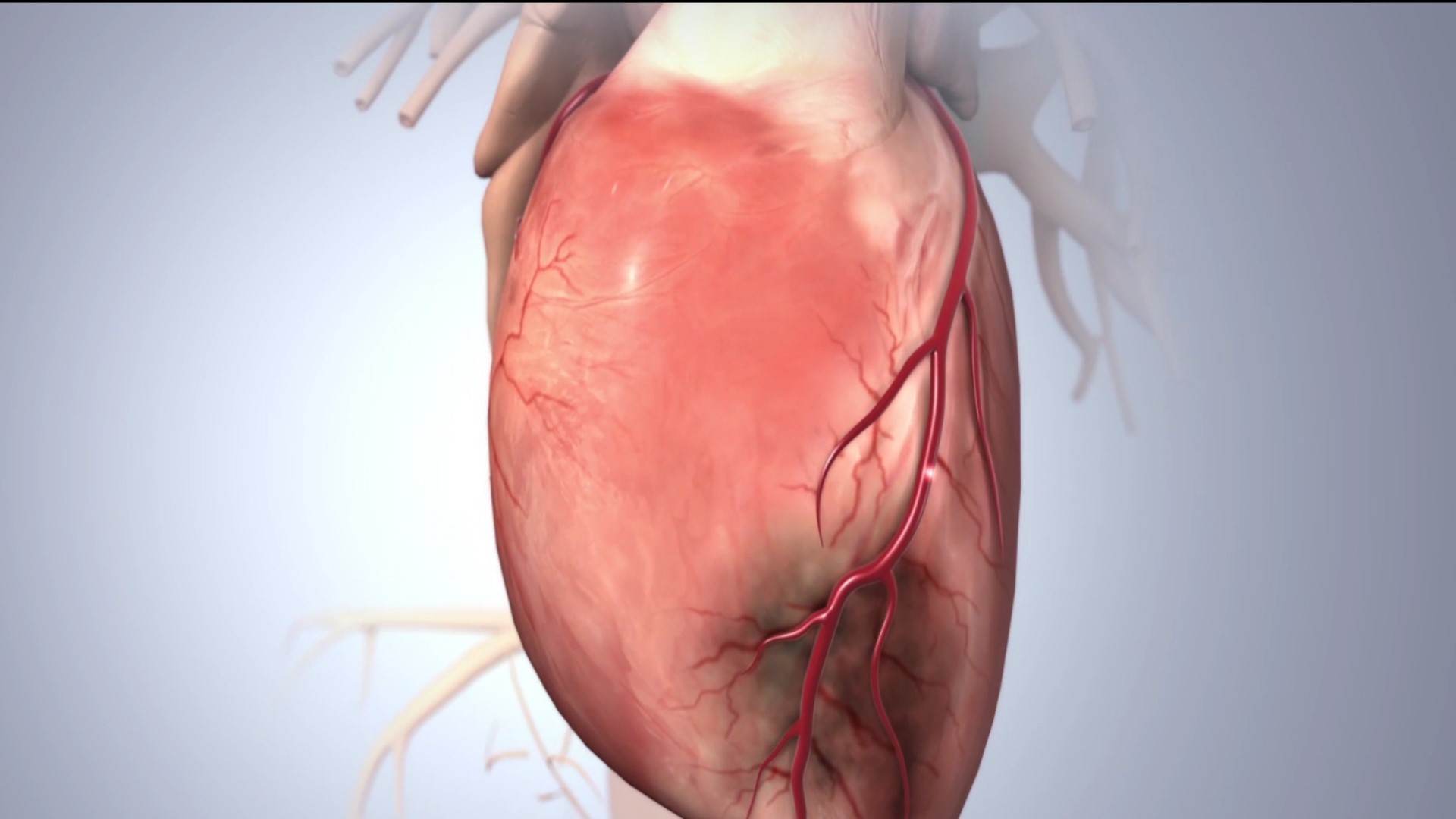ST elevasyonlu miyokart enfarktüsü, STEMI