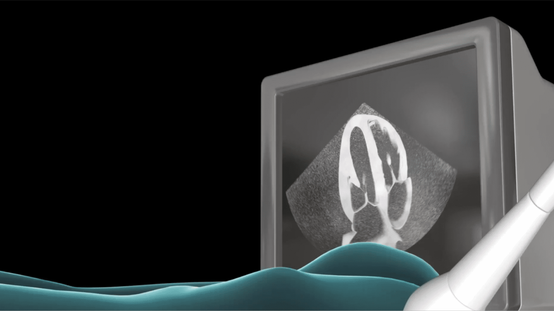 EKO (Kalp Ultrasonu)